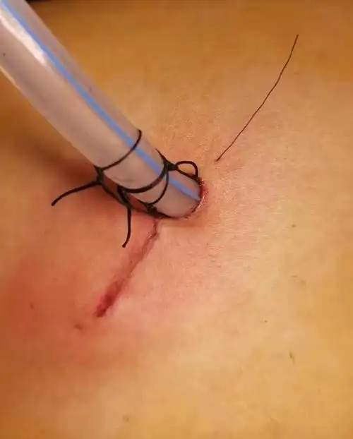 小单孔大文章胸外科成功开展我院首例单孔胸腔镜手术