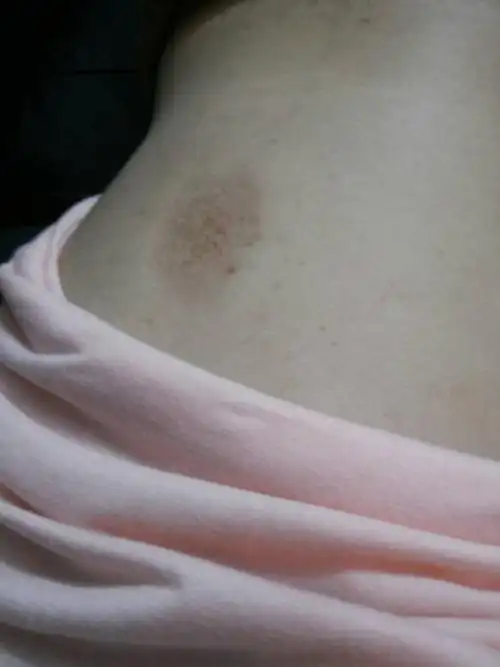 我的背部长了紫黑色的大斑点,不疼不痒