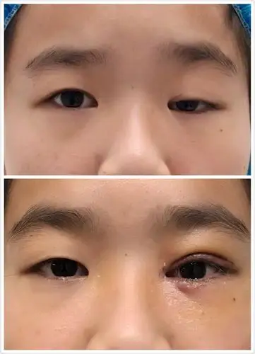 提肌无力重度上睑下垂术后"露白"情况