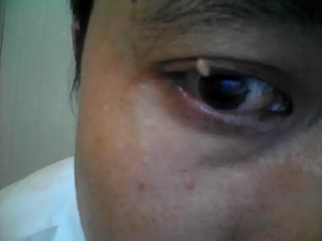 眼皮上长一个白色无痛疙瘩(见图),请问原因及治疗方法