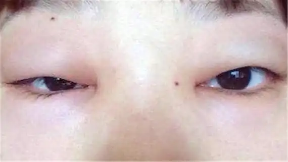 眼睛浮肿是什么原因引起的 眼睛浮肿怎么办 轻度肾炎眼睛浮肿图片