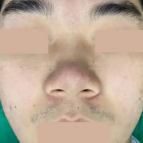 外切 内切缩鼻翼#缩鼻翼