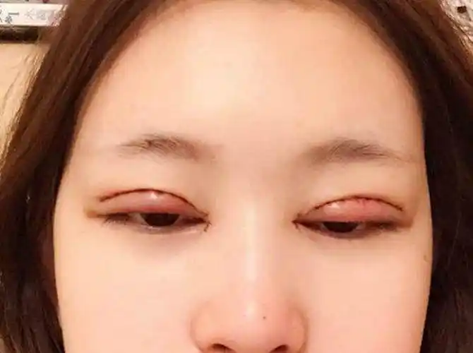 埋线双眼皮结节图片