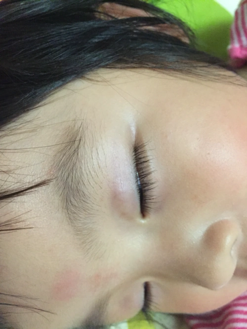 [2013年7月妈妈帮]宝贝左眼上眼皮鼓了一小个包.