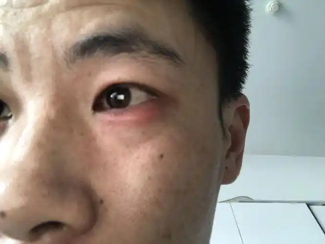 眼睛下眼袋发红