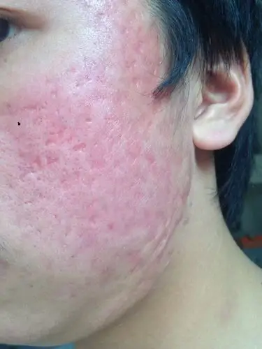 一年多了开始是脸上化脓全脸都是医生说是