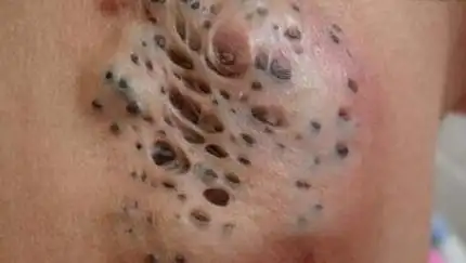 恶心慎入莲蓬乳图片大全莲蓬乳是什么蝇蛆病造成乳房溃烂