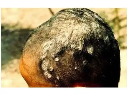 头皮癣早期症状图片5