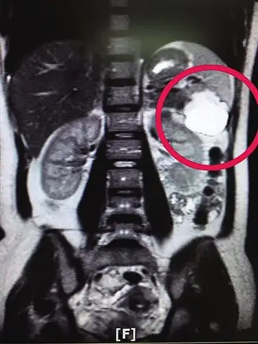 眼看着孕期已经3个月,但b超检查却怎么也找不到子宫里的胎儿