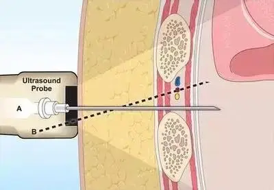 胸腔穿刺术操作流程
