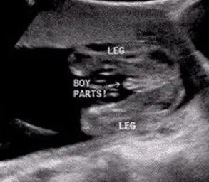 转帖哦,,精心收集男宝女宝b超图片数张!附b超特徵总结!