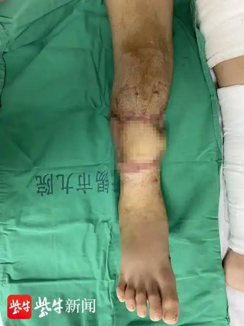 较重,骨头粉碎,断端缺损较多,所以一开始要做骨头短缩再进行再植手术