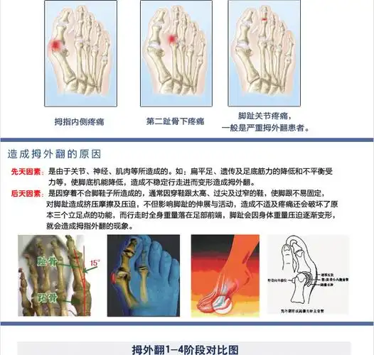 淘金币 敏斯特正品 拇外翻分趾垫 拇囊炎疼痛套 大脚骨疼痛护理套