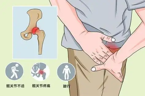 如何早期知道糖皮质激素引起的股骨头坏死?