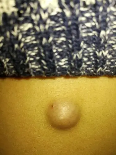 我的背上长了个瘤子两年多了,软的,不疼,请问这是什么要不要去割掉