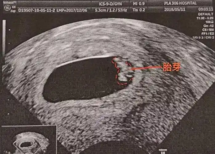 什么是胎芽胚芽