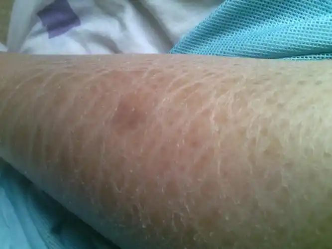 感觉像鱼鳞,洗澡也没办法,颜色和别的不一样,特别干