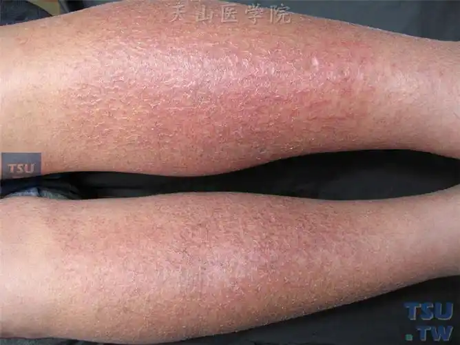 【附图】 湿疹(eczema)的症状表现〔慎入〕_皮肤病诊断图谱 | 天山