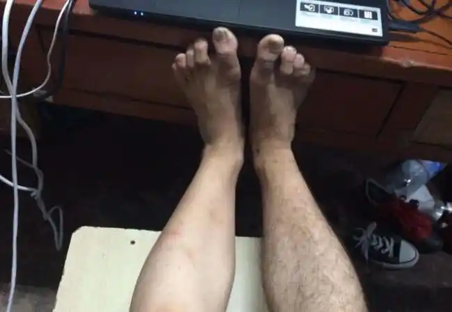 腿毛太多是激素分泌混乱?医生的答案很真实,网友:以后不刮了