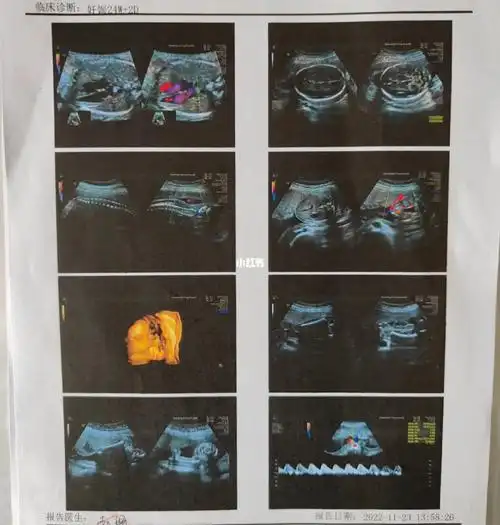 前不停走来走去不过边缘性脐带入口和胎盘血池是什么鬼尽管医生说没事