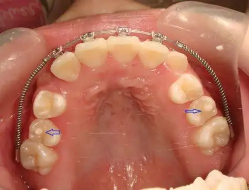 牙医说容易受伤的畸形中央尖