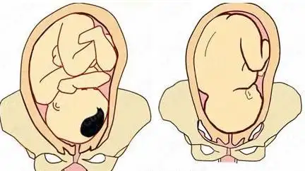 三个方法快速判断宝宝胎位正不正