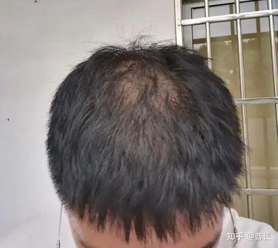 22岁大三男生溢脂性脱发自救记录使用非那雄胺和米诺地尔