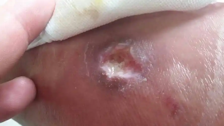 小腿表面起个小红包,之后变成溃疡面,现在有个深深的坑儿,一年之前长