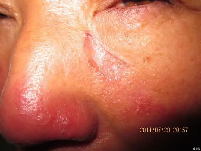 面部皮损的诊断