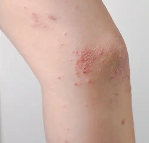 如继发感染可形成脓疱毛囊炎等,有剧烈的瘙痒感2亚急性期的湿疹一般是