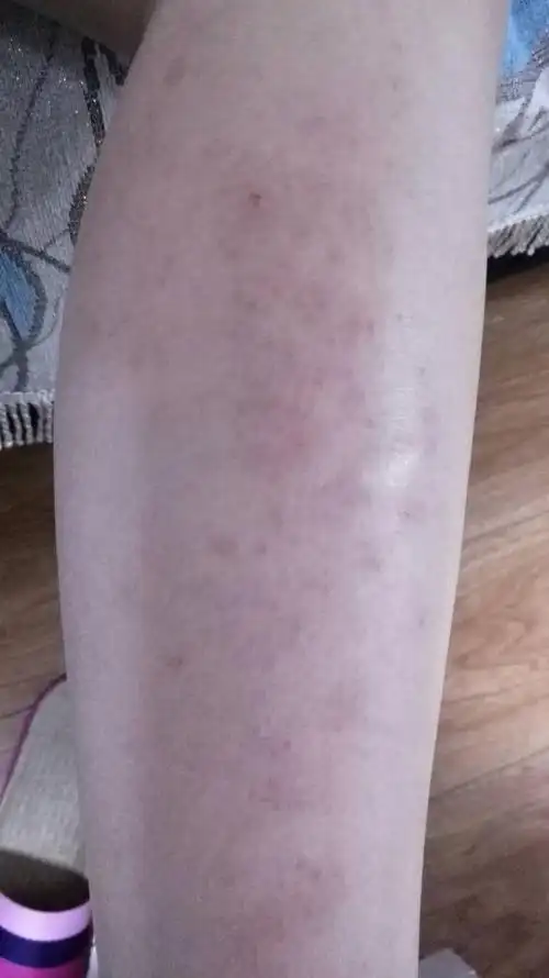 我老婆怀孕五个多月了,今天突然腿上起了图片这样的红斑,求教高人赐教