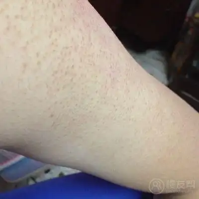 手臂上好像是鸡皮肤.