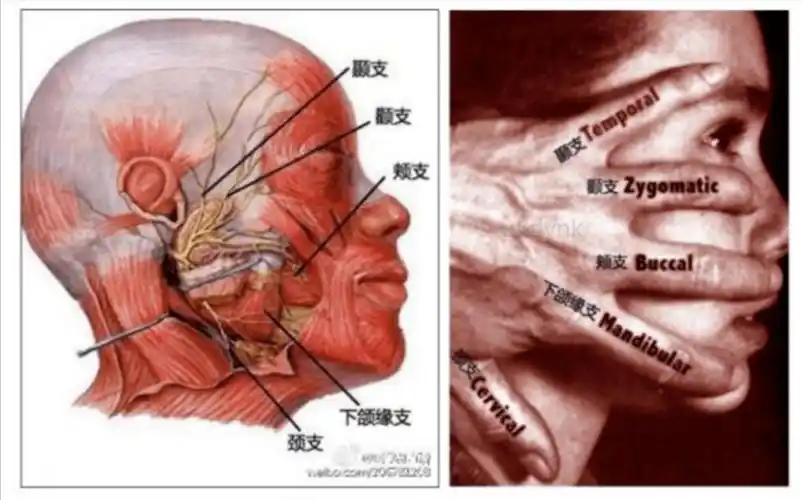 几幅图带你认识面神经,了解面瘫, 懂得治疗_针灸