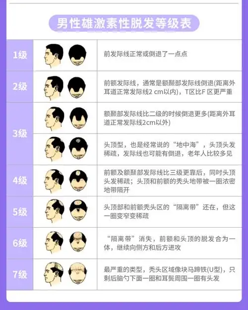 那就给大家用一张图来解答一下脱发等级.