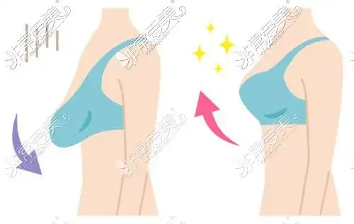 断奶后胸软趴趴都是皮下垂明显分享我断奶后胸部恢复经历