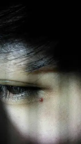 眼角上长了个红色的小疙瘩?不知道是啥.怎么弄好啊