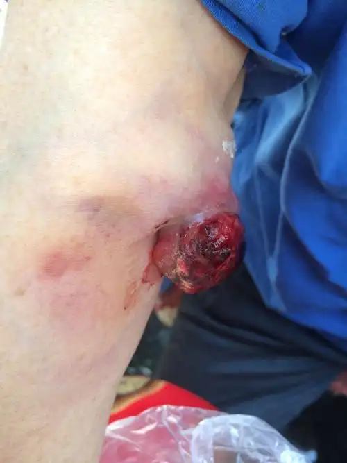 常见的还有平滑肌瘤,淋巴肉瘤,滑膜肉瘤等,早期即可发生血行转移.