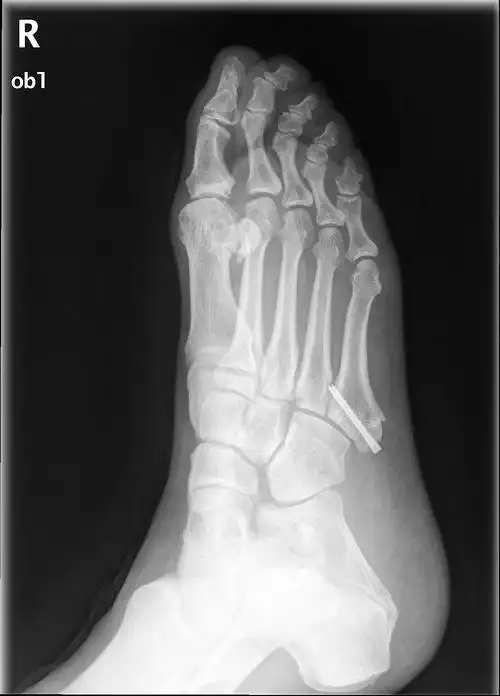 第5跖骨基底部骨折