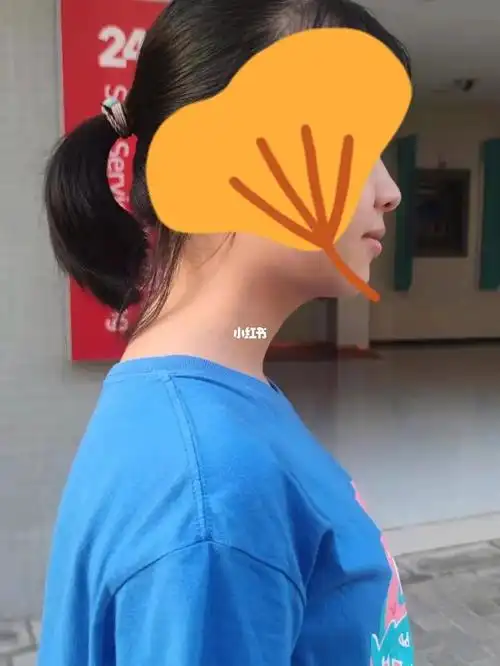 脖子前倾驼背01