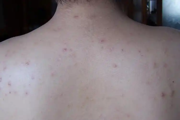 颈部,前胸,后背等皮脂腺丰富的部位,表现为粉刺,包括白头,黑头粉刺