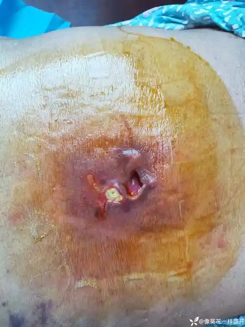 求助令人头疼的皮肤坏死