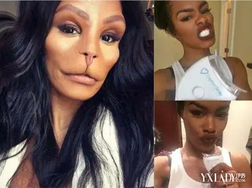 【图】美国名媛整容成猴脸 脸部整形并发症和后遗症不少