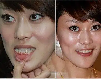 牙齿矫正最快速方法:纯韩仿生美牙冠