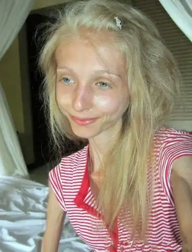 俄罗斯女模特绝食减肥变"活骷髅",体重仅有21公斤