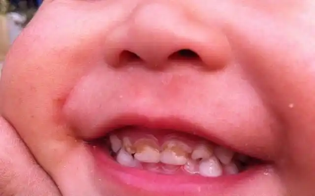 乳牙|牙齿|恒牙_新浪新闻