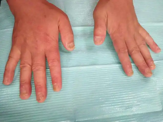 典型病例银屑病甲