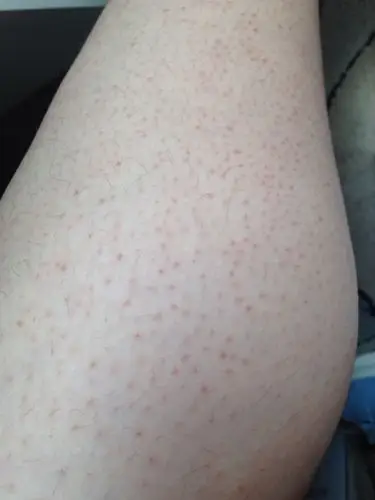 我的腿上一直就有这种点点?为什么啊?怎么去?