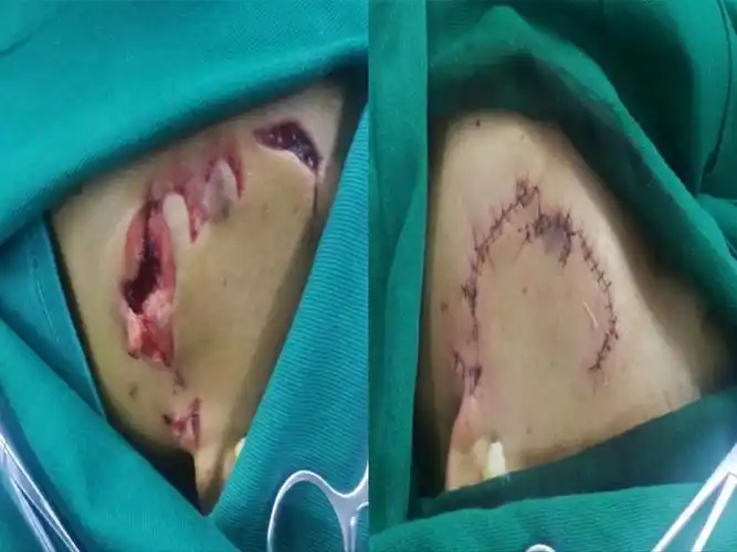 向健康与美丽出发—微创美容缝合技术