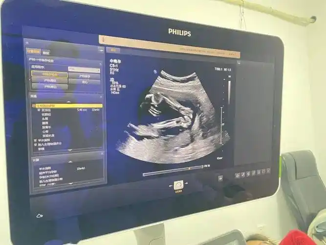 让诊疗soeasy区妇计中心引进新型飞利浦彩超旗舰机