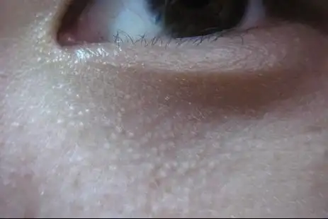 我脸上这是不是脂肪粒(有图)